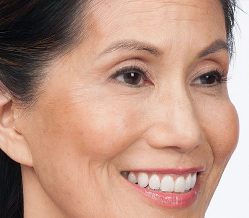 After BOTOX After BOTOX image