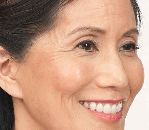 Before BOTOX Before BOTOX image