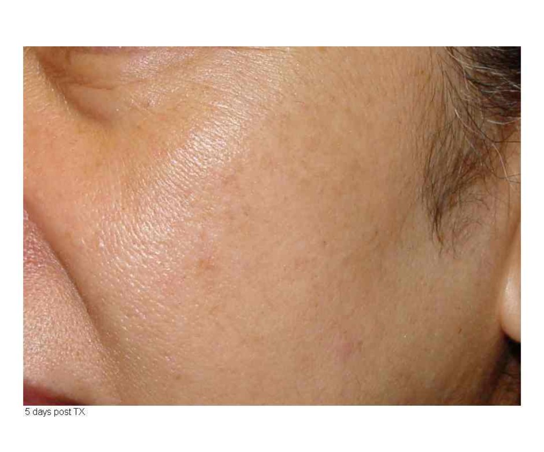 Lime Light Facial 82