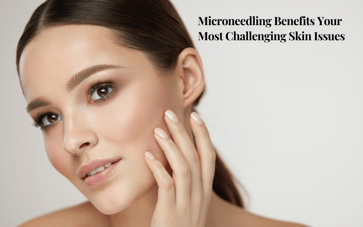 Microneedling Benefits Your Most Challenging Skin Issues