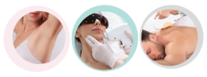 Laser hair removal underarm, chin hair, back hair