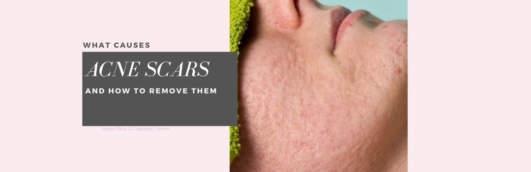 What Causes Acne Scars, and How to Heal Them Permanently