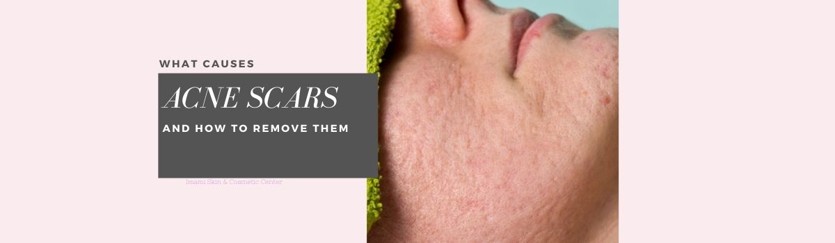 "What causes acne scars and how to remove them". Face of person lying down, with acne scars, and green towel covering eyes.
