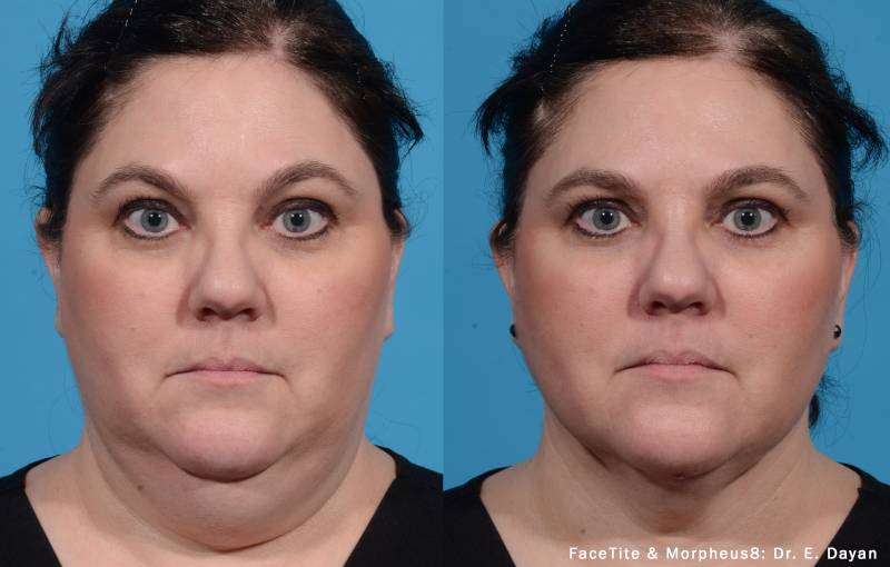 FaceTite before and after