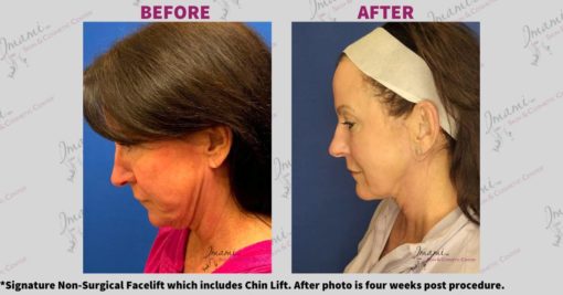 before and after NS chin lift