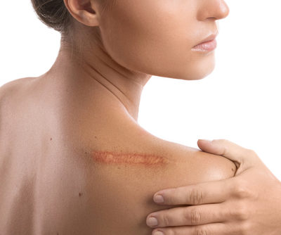 scar on shoulder