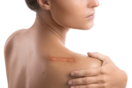 scar on shoulder