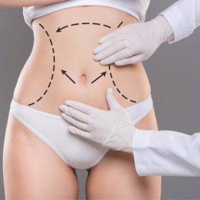 tummy tuck