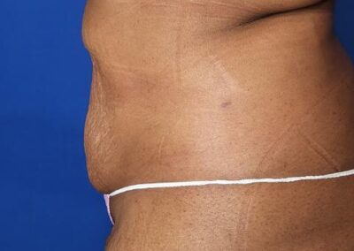 After picture of patient who had liposuction