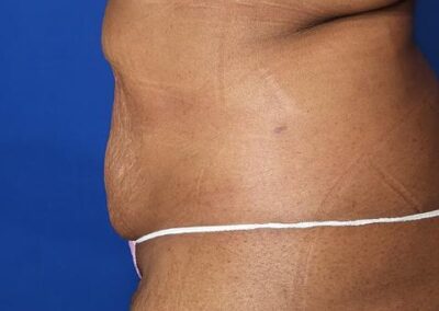 After picture of patient who had liposuction