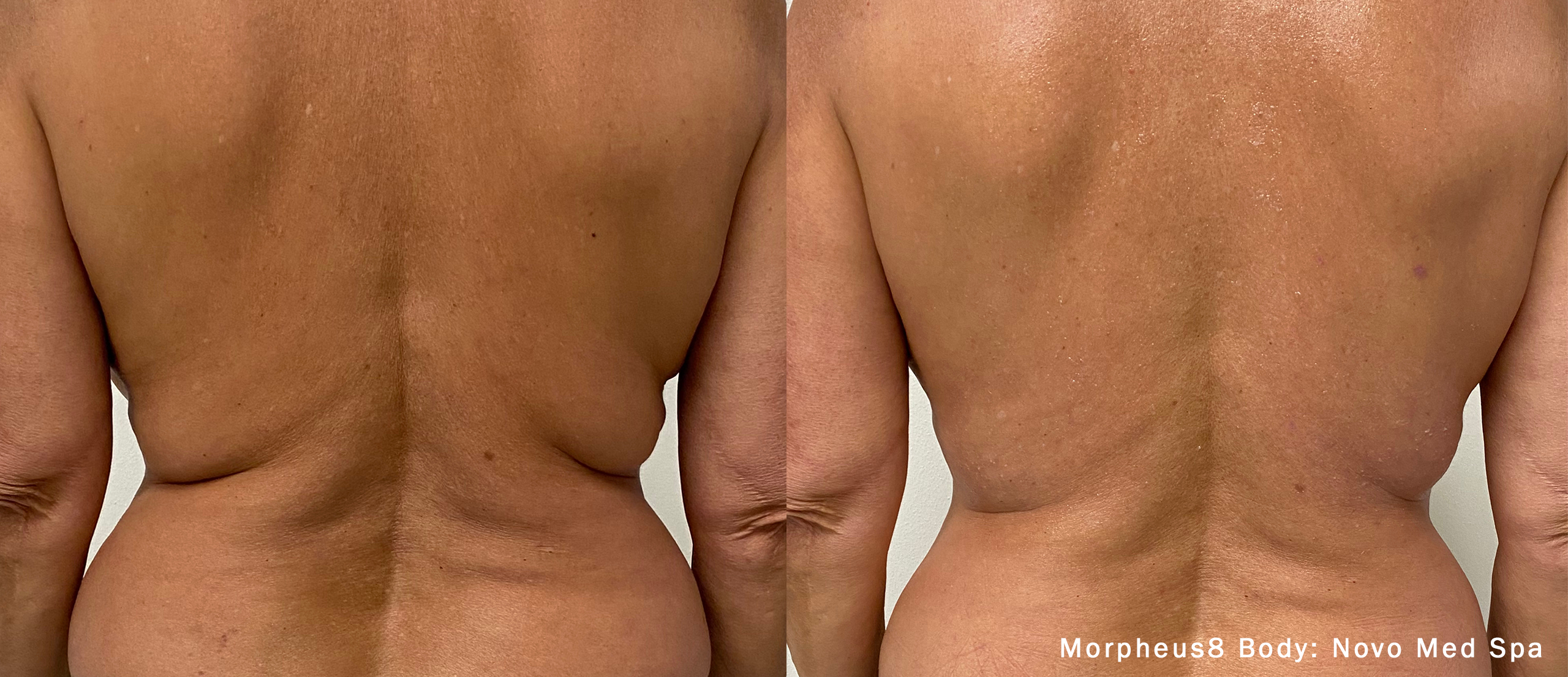Before and After of Morpheus8 Body Treatment 